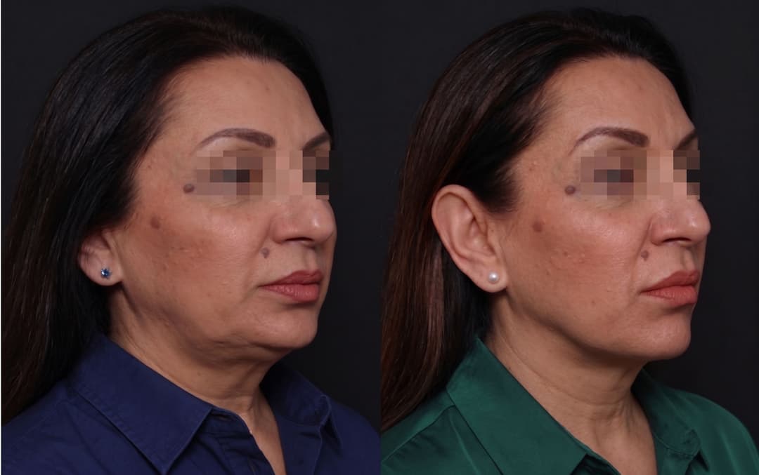 Exilis Before After: Hasil & Perubahan Sebelum Sesudah Treatment