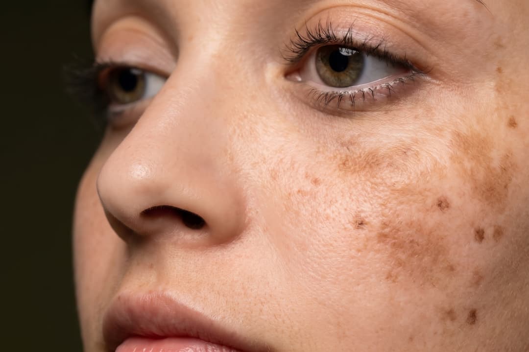 Ini Alasannya DNA Salmon Jadi Jawaban untuk Flek Hitam & Melasma